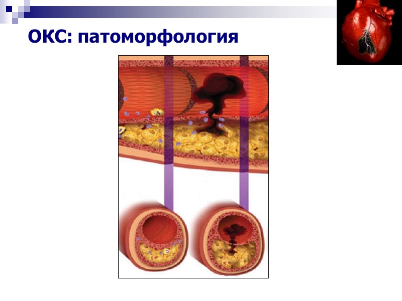 ОКС: патоморфология
